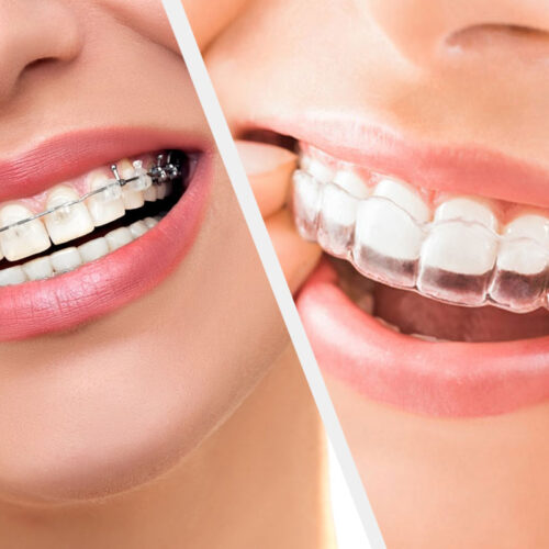 Aparat dentar safir versus gutiere invizibile Spark sau Invisalign Aparat dentar safir versus gutiere invizibile Spark sau Invisalign