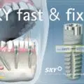 Implant dentar Sky Fast and Fixed Bredent pret Bucuresti