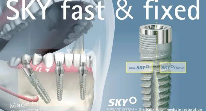 Implant dentar Sky Fast and Fixed Bredent pret Bucuresti