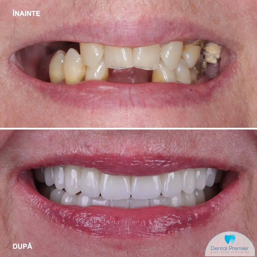 Pacienta 65 ani – Implant dentar si dinti ficsi in 24 ore la maxilar si mandibula