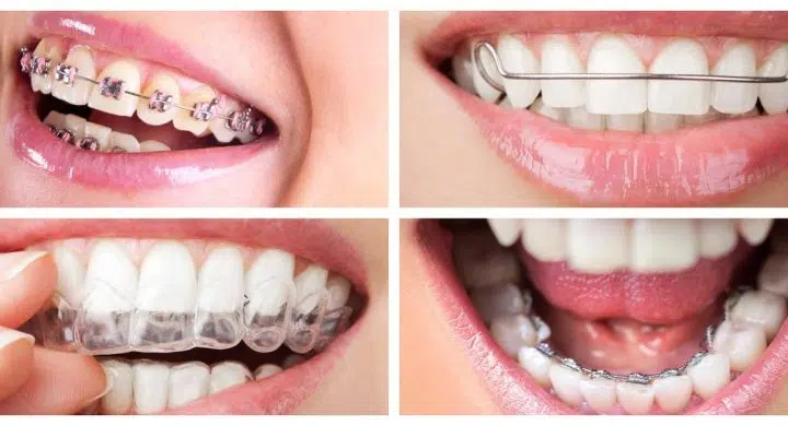Pret aparat dentar fix versus pret aparat dentar mobil
