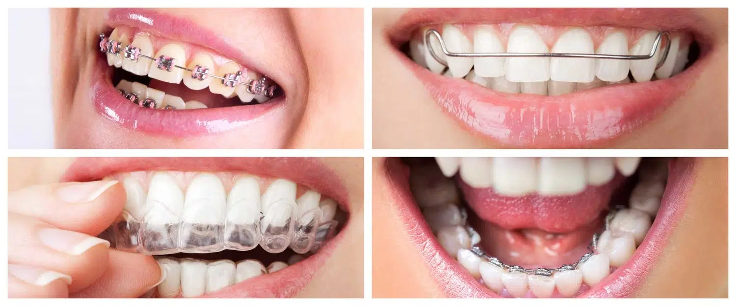 Pret aparat dentar fix versus pret aparat dentar mobil