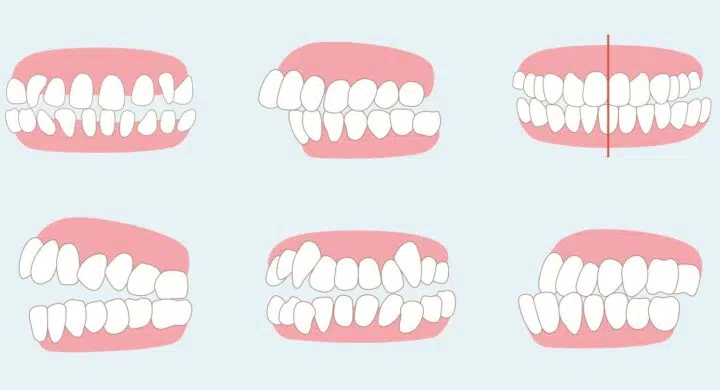Tipuri de ocluzii si malocluzii dentare