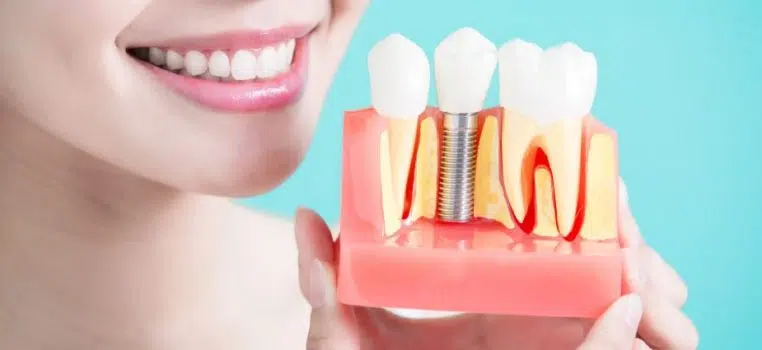 Cat dureaza un implant dentar? Operatie si durata de viata