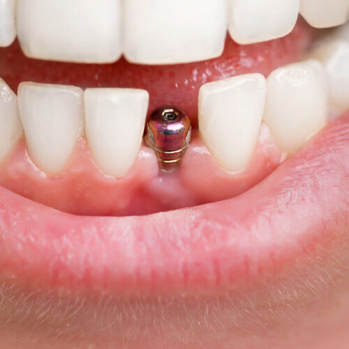 Dupa implantul dentar Dupa implantul dentar