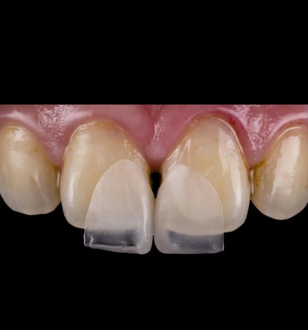 Fatete dentare minimal sau no prep