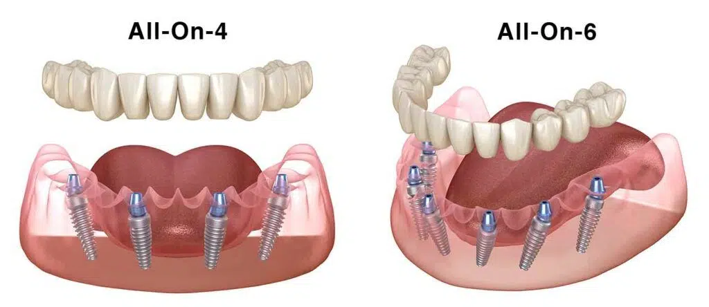 Proteze fixe pe implant dentar All-on-4 si All-on-6: pret si tipuri Proteze fixe pe implant dentar All-on-4 si All-on-6: pret si tipuri