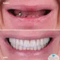 Lucrare fixa pe 6 implanturi dentare