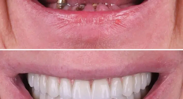 Lucrare fixa pe 6 implanturi dentare