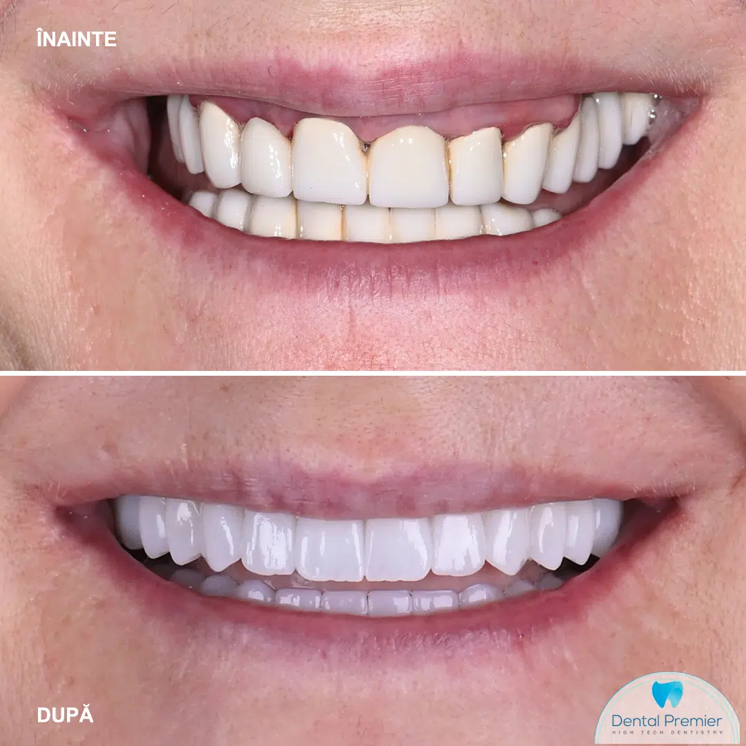Pacienta 57 ani dupa lucrare fixa pe 6 implanturi bimaxilar – rezultat final Dental Premier Bucuresti