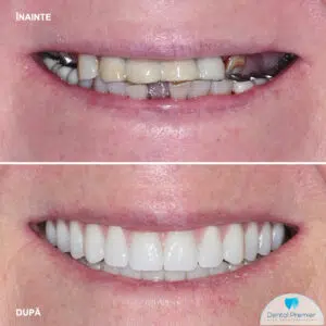 All-on-6 - Proteze dentare fixe cu 6 implanturi All-on-6 - Proteze dentare fixe cu 6 implanturi
