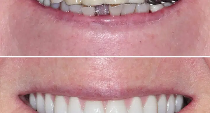 All-on-6 - Proteze dentare fixe cu 6 implanturi