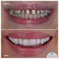 Fatete dentare before and after - Cazuri clinice inainte si dupa aplicarea fatetelor