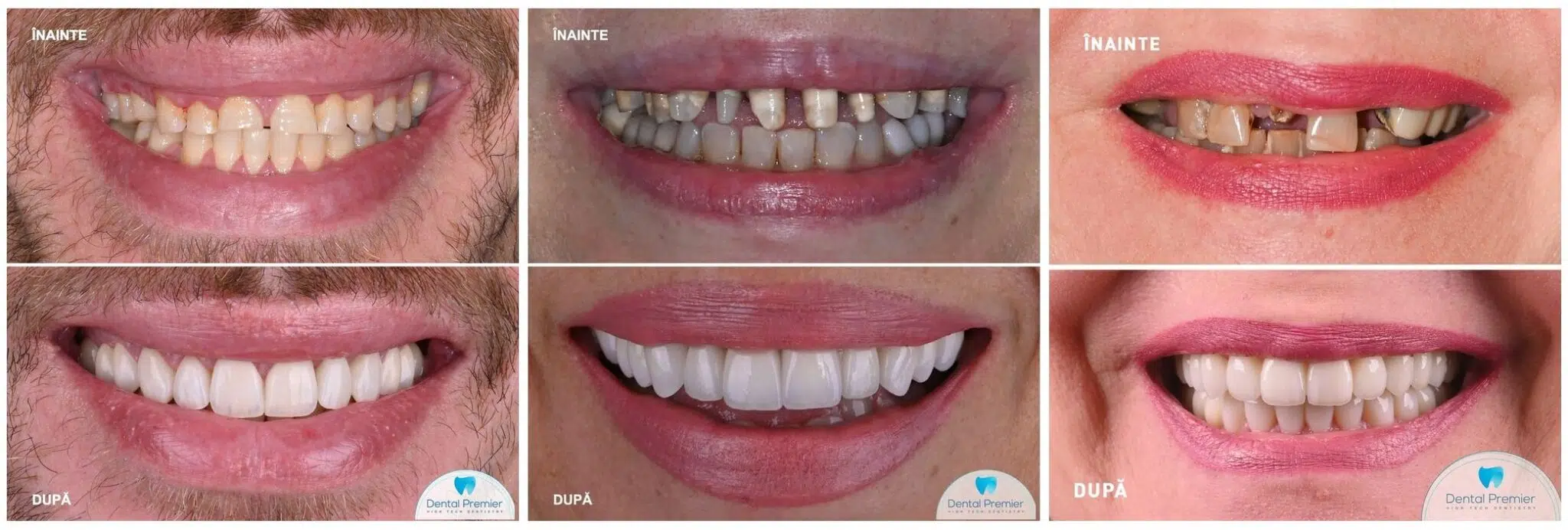 Fatete dentare before and after - Cazuri clinice inainte si dupa aplicarea fatetelor
