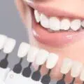 Fatete dentare din zirconiu – recomandari, avantaje, dezavantaje si preturi