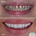 Coroane ceramice pe suport de zirconiu