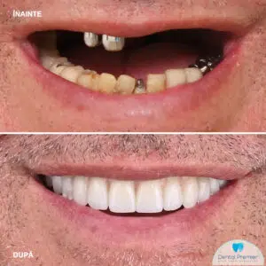 Lucrari fixe pe 6 implanturi la maxilar si mandibula Lucrari fixe pe 6 implanturi la maxilar si mandibula