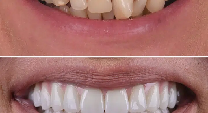 Lucrare fixa pe 6 implanturi All-on-6