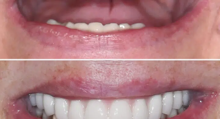 Dinti ficsi pe 4 implanturi - Lucrare fixa All-on-4