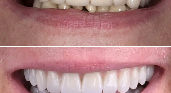 Lucrare fixa pe 4 implanturi