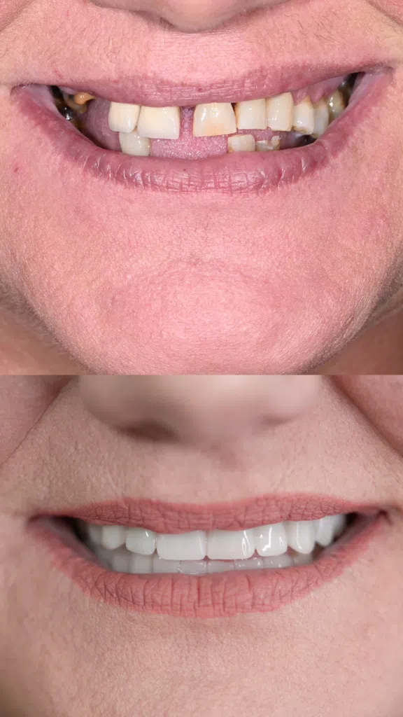 Protocol All-on-X-before-after-lucrari-fixe-provizorii Inainte si dupa lucrari fixe pe implanturi dentare All-on-4 si All-on-6