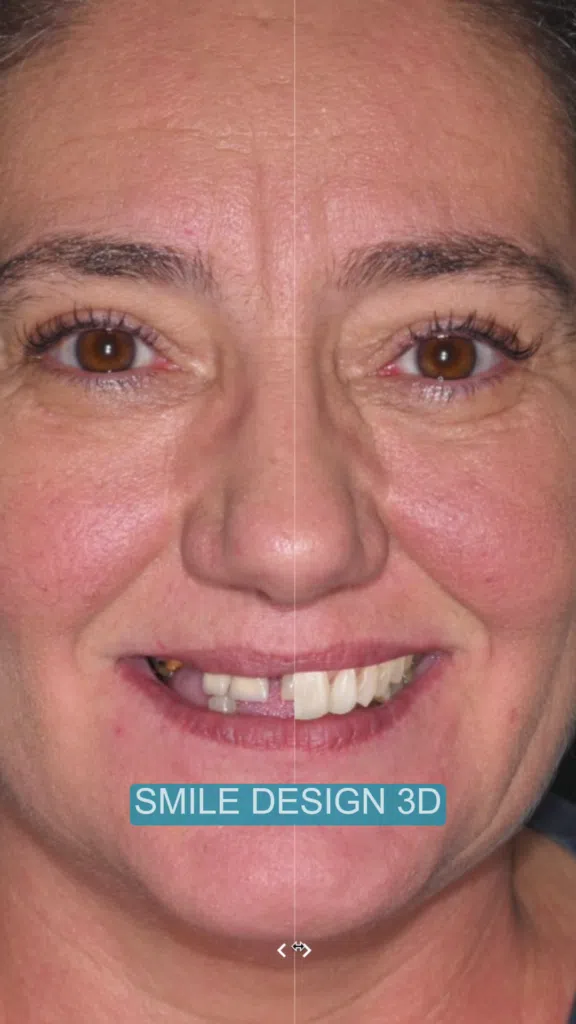 Protocol All-on-X-digital-smile-design-3D Digital Smile Design