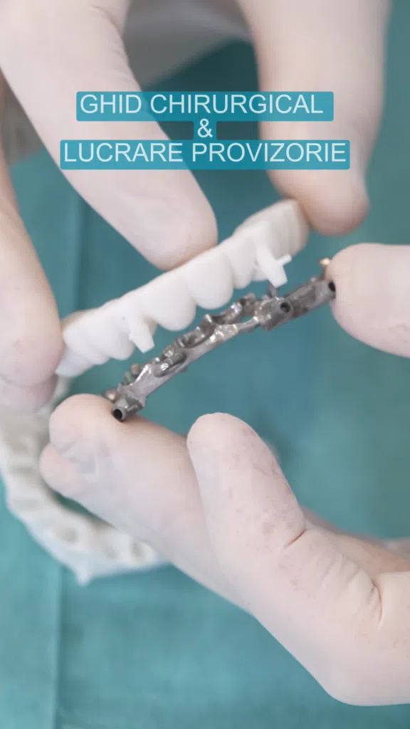Ghid chirugical pentru implanturi si lucrare provizorie Ghid chirugical pentru implanturi si lucrare provizorie