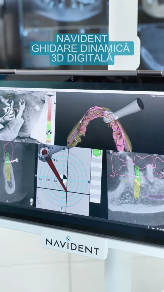 Protocol All-on-X-ghidare-Navident Ghidare digitala cu Navident