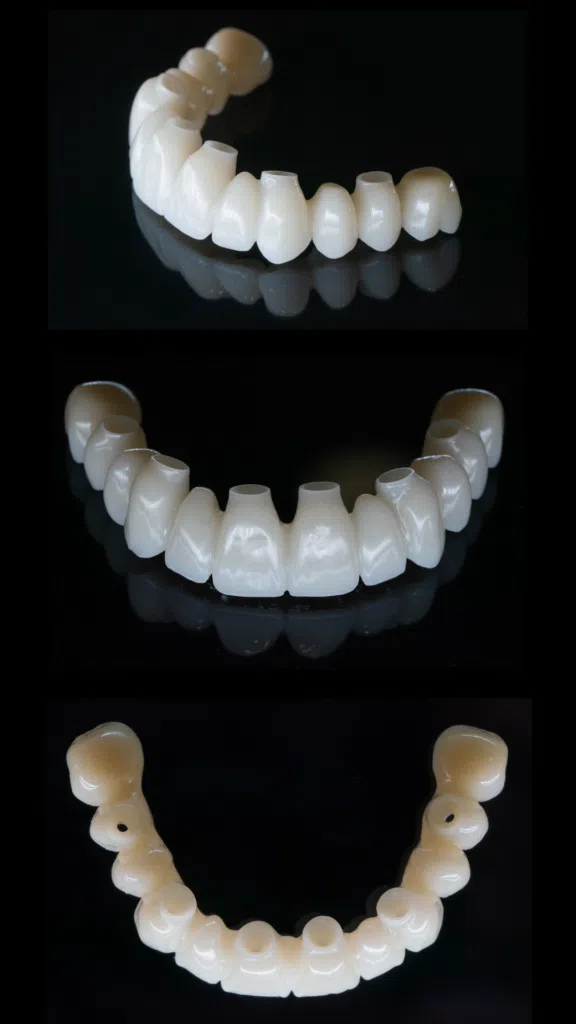 Protocol All-on-X-lucrari-fixe-provizorii Lucrare dentara fixa provizorie