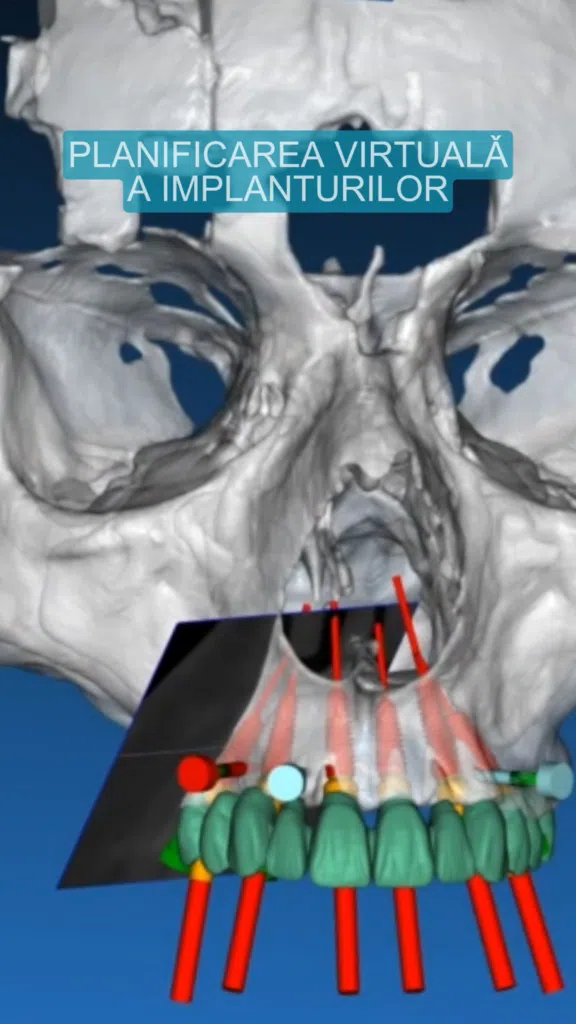 Protocol All-on-X-planificarea-virtuala-implanturi Planificarea virtuala a implanturilor