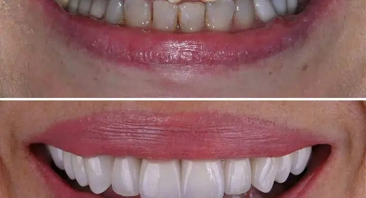 garantie dinti portelan vs garantie dinti zirconiu pentru un zambet estetic