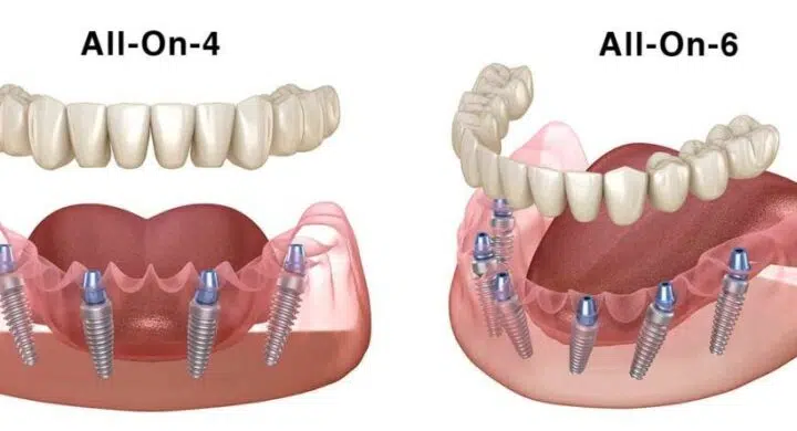 All-on-4 sau All-on-6: criterii medicale reale (maxilar vs mandibula, os, bruxism, muscatura)