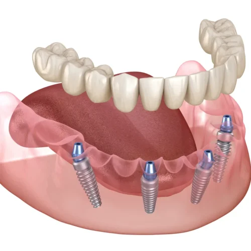 cantilever-all-on-4-mandibula Cantilever punte dentara totala pe 4 implanturi la mandibula