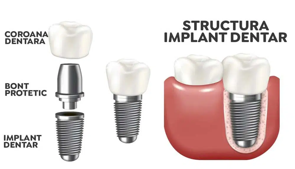 Structura cost implant dentar complet Structura cost implant dentar complet