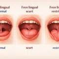 Frenectomie linguala laser - Operatie fren lingual pret