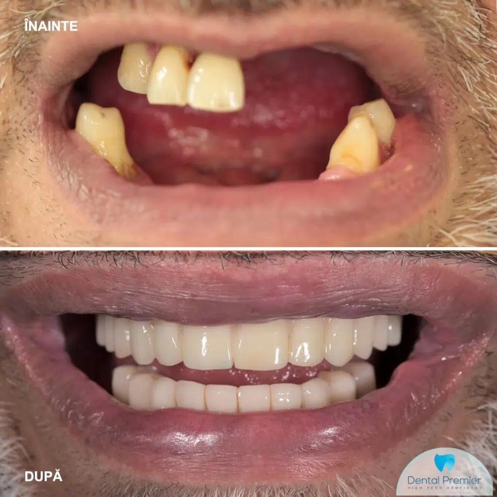 Pacient 43 ani - Implant subperiostal personalizat la maxilar + Fast and Fixed 4 implanturi la mandibula Implant dentar subperiostal la maxilar + Fast and Fixed 4 implanturi la mandibula