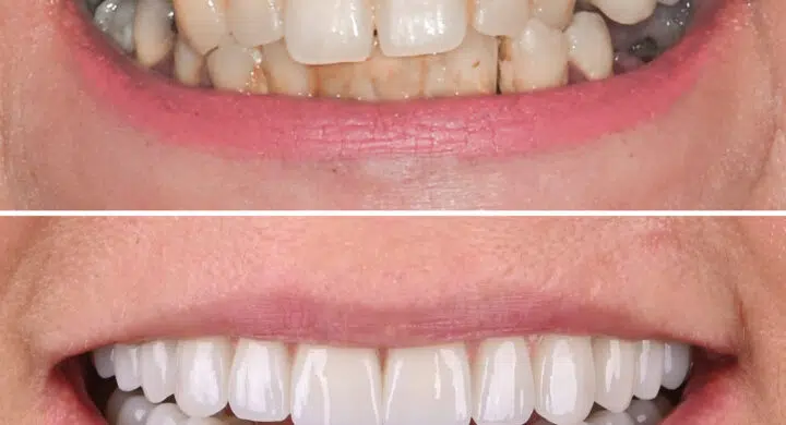 Dantura fixa pe implanturi Straumann Pro Arch All-on-4 si All-on-6