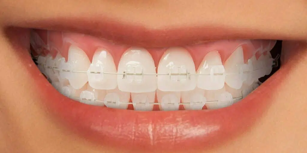 Aparat dentar ceramic Aparat dentar ceramic