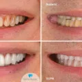 Fatetele din ceramica feldspatica vs Fatetele Emax din disilicat de siliciu