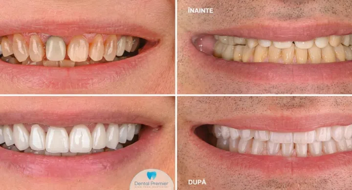 Fatetele din ceramica feldspatica vs Fatetele Emax din disilicat de siliciu