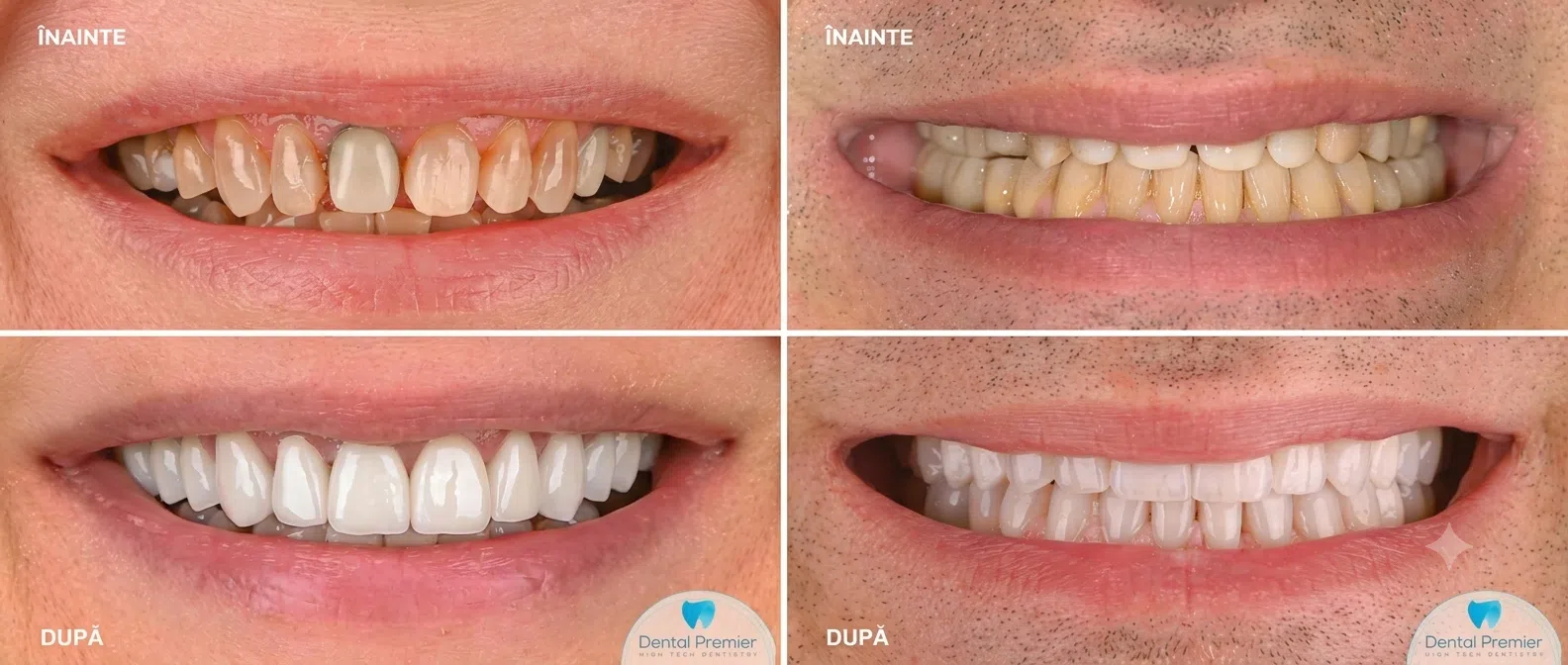 Fatetele din ceramica feldspatica vs Fatetele Emax din disilicat de siliciu