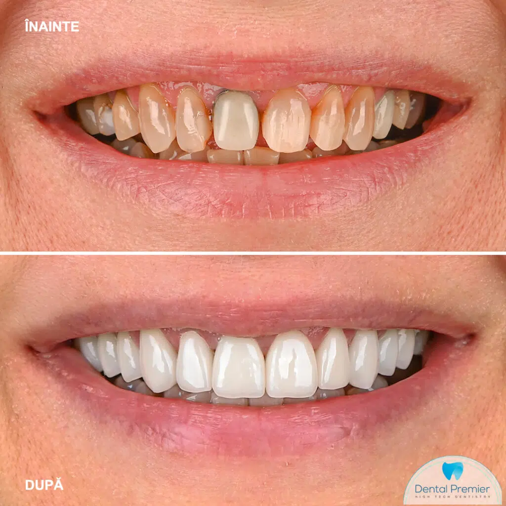 Inainte si Dupa Fatete dentare ceramice Emax Bucuresti Inainte si Dupa Fatete dentare ceramice Emax Bucuresti