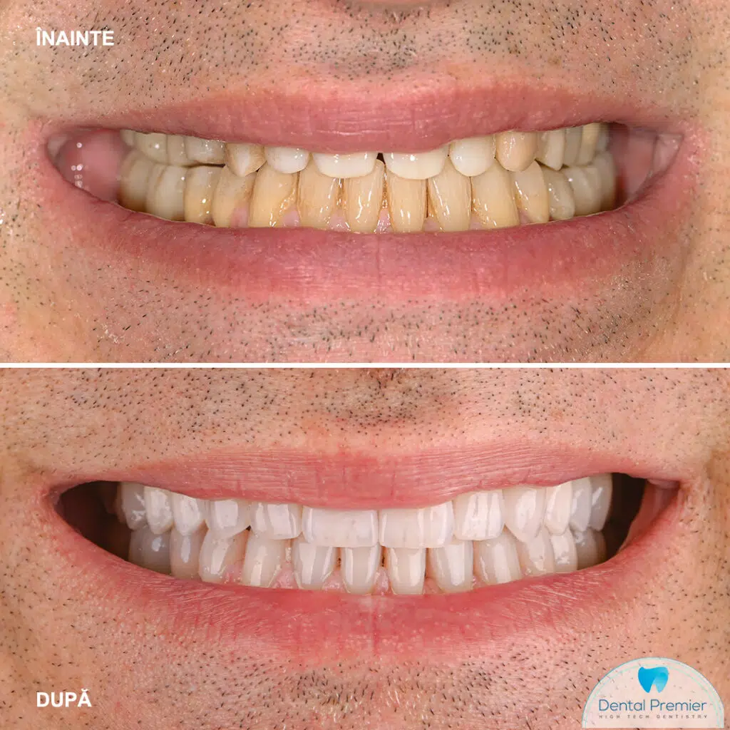 before and after fatete dentare ceramice feldspatice premium before and after fatete dentare ceramice feldspatice premium