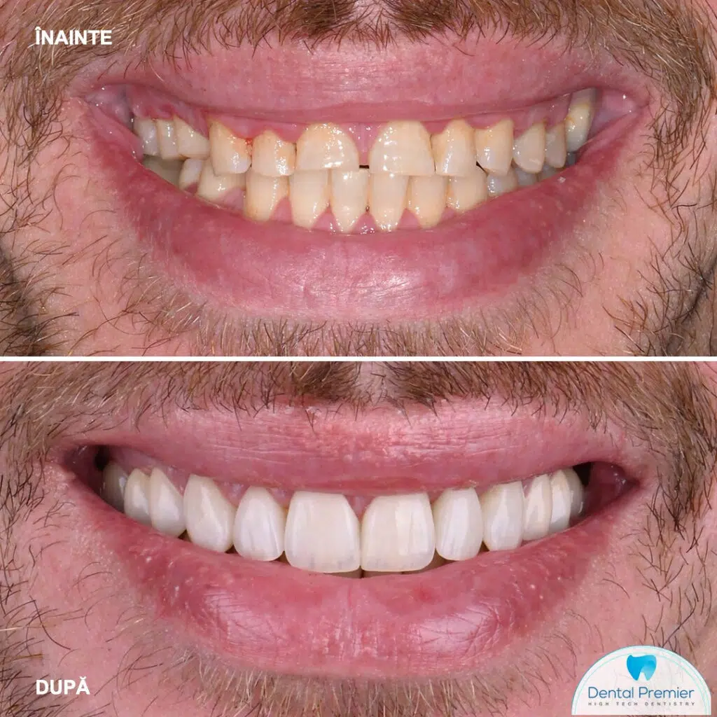 Pacient 36 ani - Fatete dentare ceramice Emax si coroane integral ceramice Pacient 36 ani - Fatete dentare ceramice Emax si coroane integral ceramice