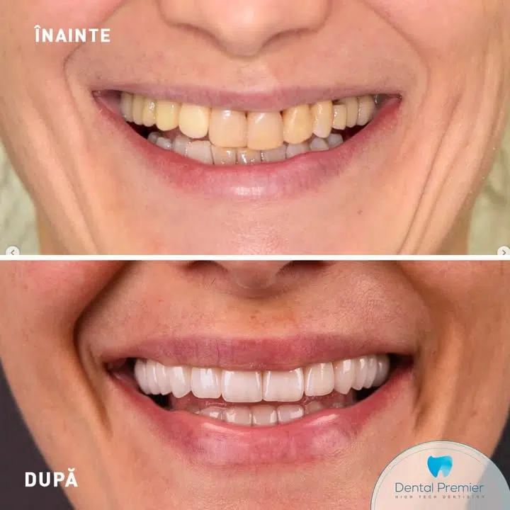 Pacienta 42 ani - fatete ceramice emax si coroane integral ceramice Pacienta 42 ani - Fatete ceramice Emax si coroane integral ceramice
